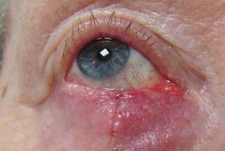1 week na de mohs chirurgie voor basaalcelcarcinoom voor het ooglid